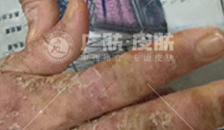 别让湿疹 “纠缠不休”！