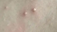 毛囊炎可以挤吗