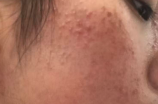 痤疮星人必看！这些食物是“痘痘催化剂”，快收好忌口清单！