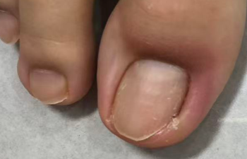 指甲总爱“闹脾气”？这份防甲沟炎指南请收好！